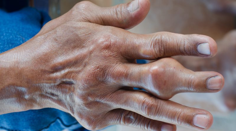 La artritis gotosa puede provocar deformidad en las articulaciones - Machete